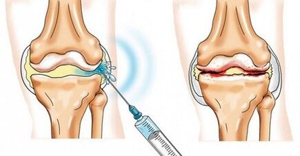 How to treat knee arthrosis joint