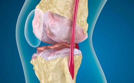 The causes of the development of knee arthrosis joint
